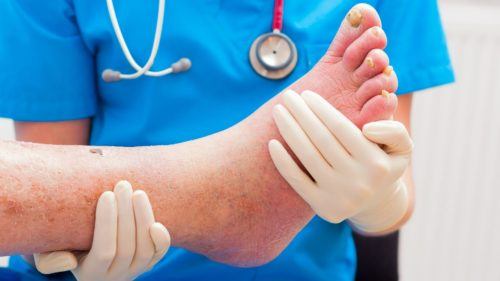 Diabetická noha - popis diagnózy a liečba