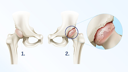 Detail of osteoarthritis - damaged hip joint