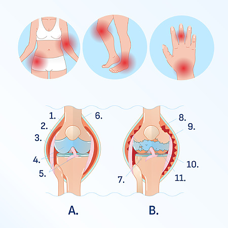 Rheumatism manifestations - the disease affects various joints