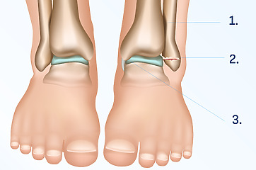 Weber A located below the syndesmosis