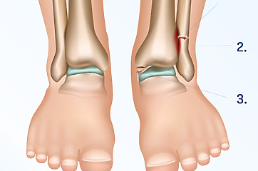 Weber B passes through the syndesmosis