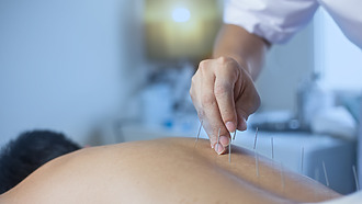 Acupuncture for sciatica