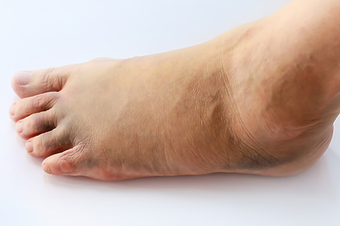 Swelling and bruising - another sign of a fracture